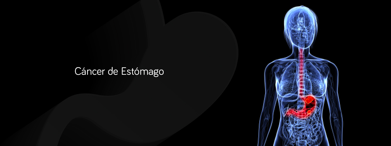 Cancer en el estomago en Monterrey