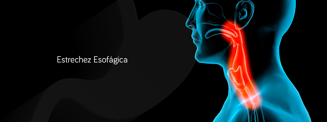 estrechez esofagica en Monterrey
