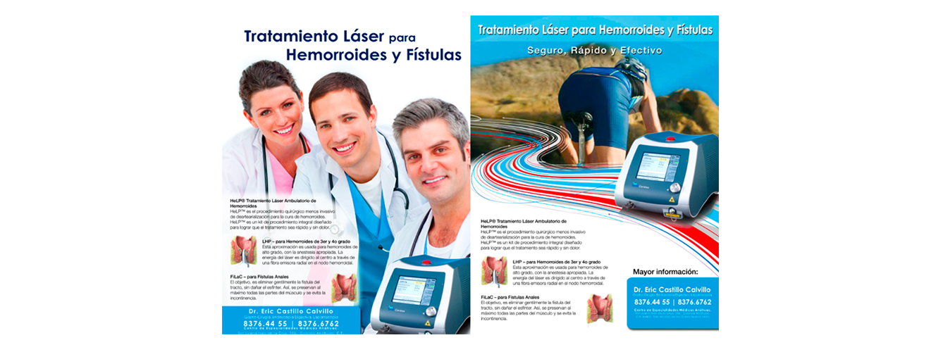 Tratamiento Laser para hemorroides en Monterrey